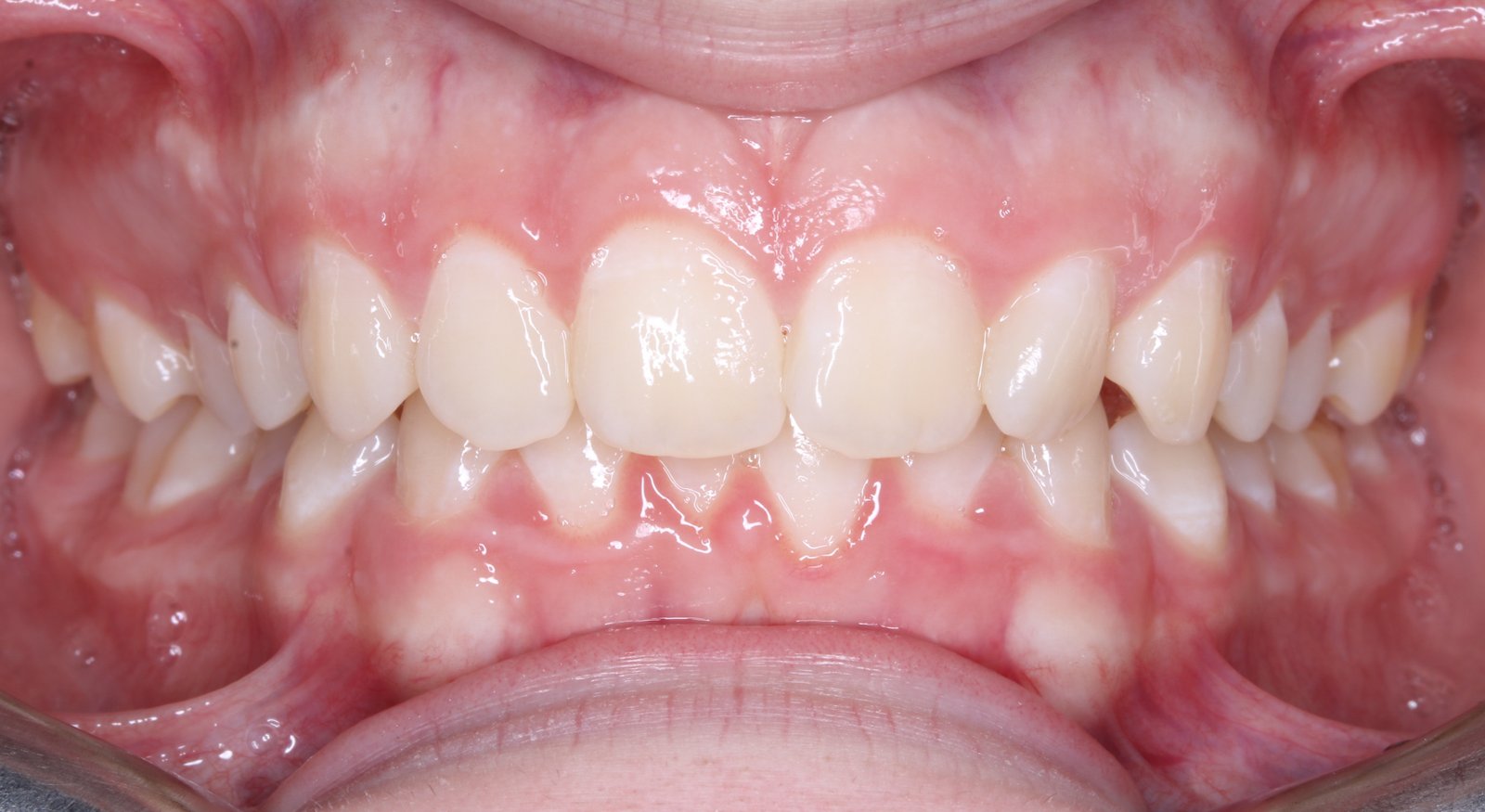 Dentadura antes del tratamiento