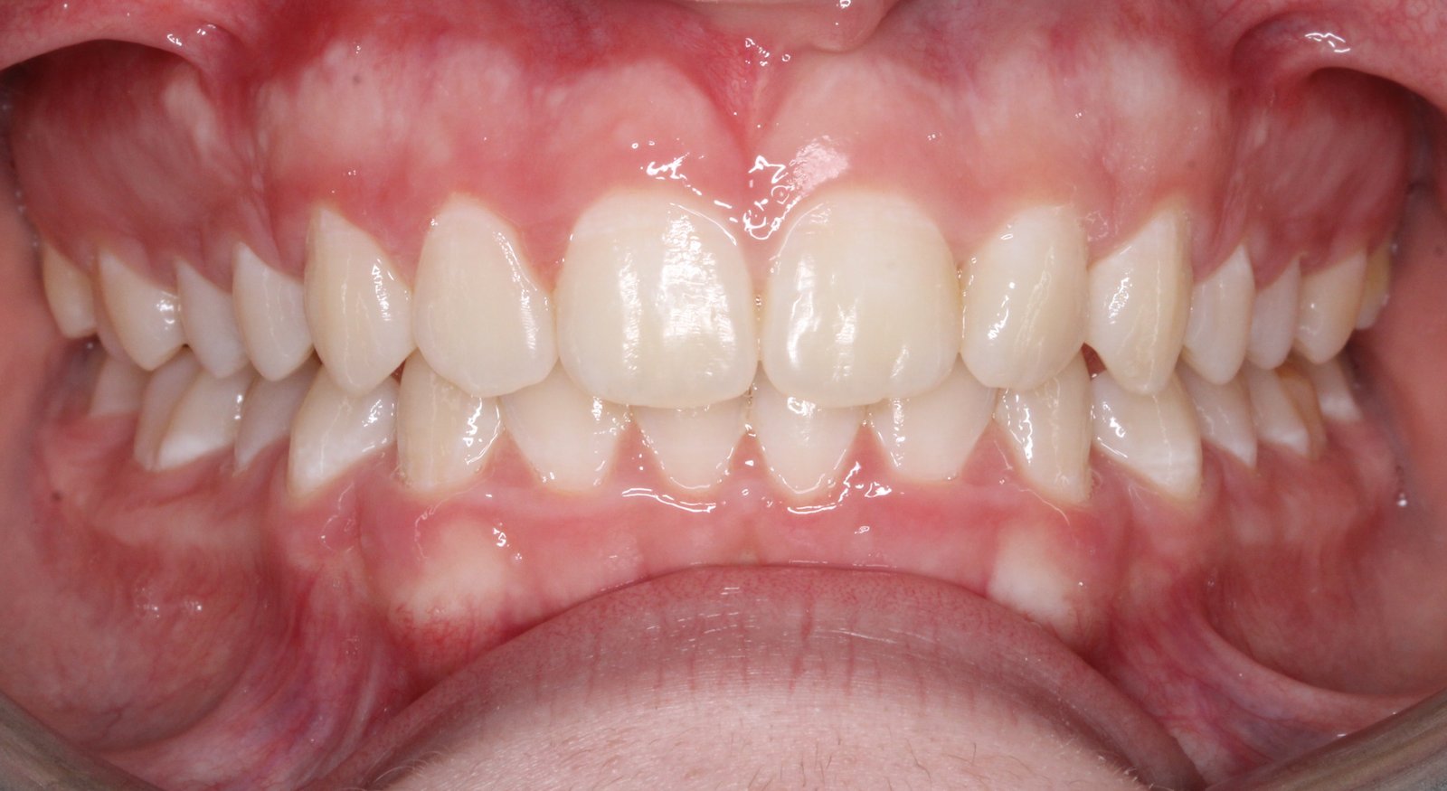 Dentadura después del tratamiento