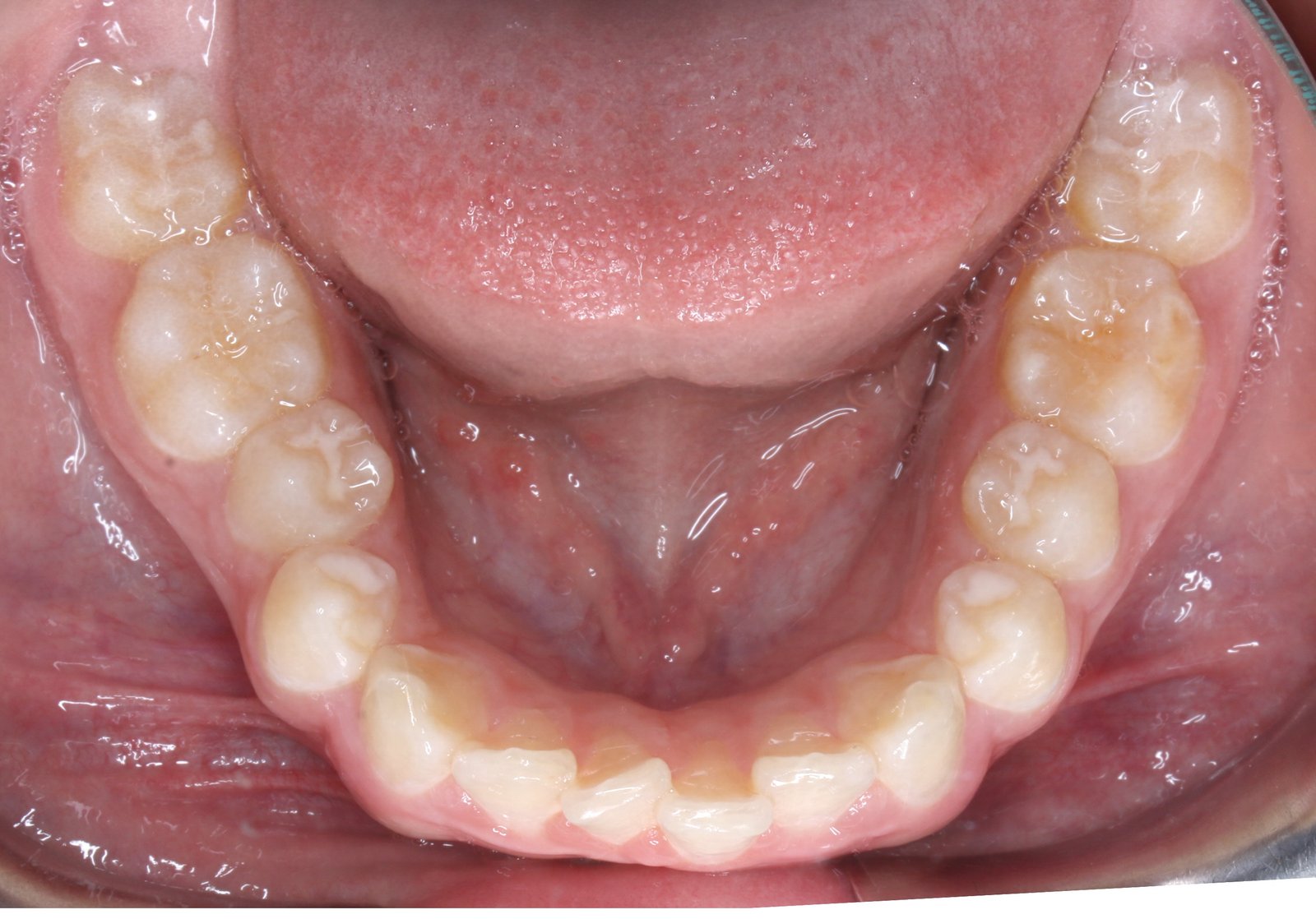 Oclusal inferior antes