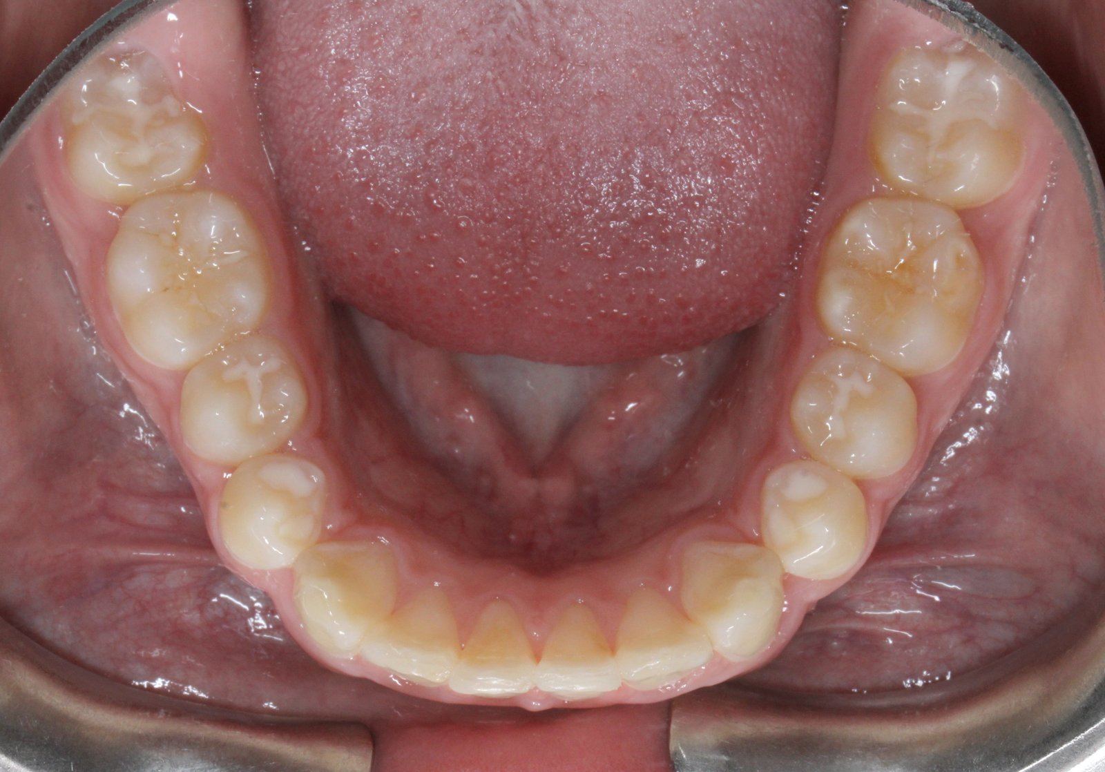 Oclusal inferior después