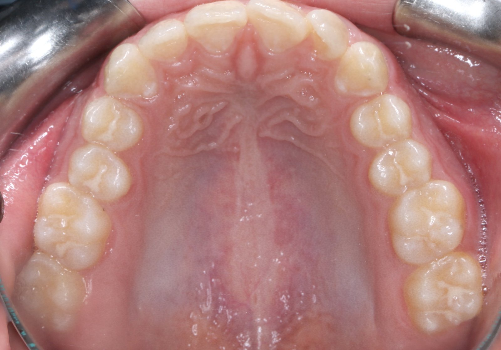 Oclusal superior antes