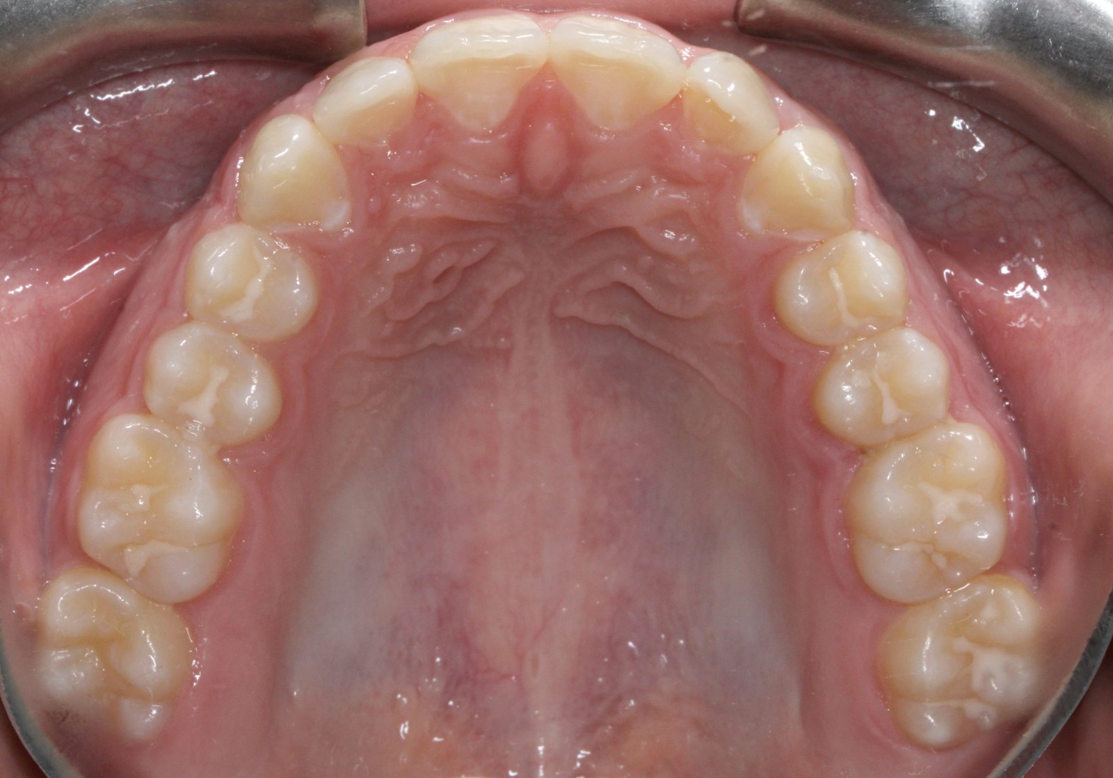 Oclusal superior después
